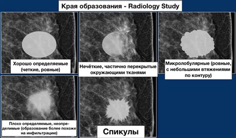 Подробности и классификация ACR типа d в маммографии
