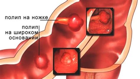 Полипы в области прямой кишки: еще один фактор возникновения кровотечения, требующий внимания