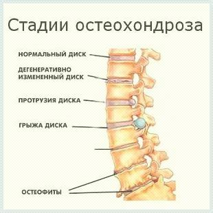 Последствия непредусмотренных изменений в структуре позвоночника