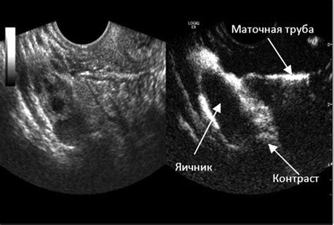 Преимущества и недостатки УЗИ маточных труб