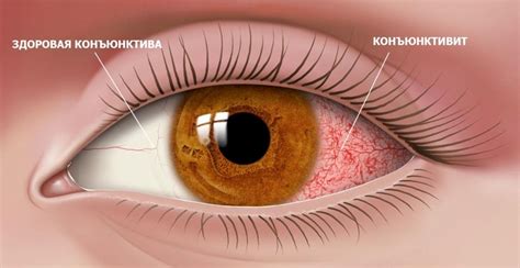 Причины возникновения гнойных ниток в глазах
