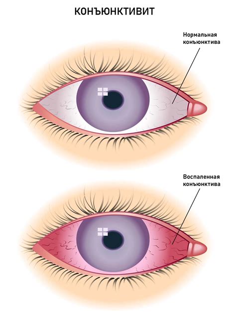 Причины возникновения конъюнктивита