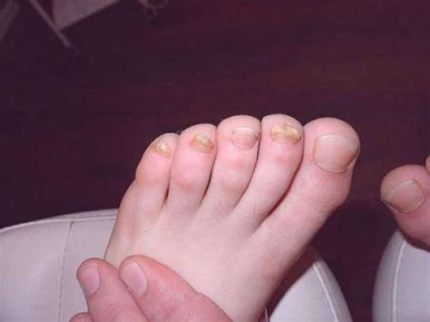 Причины возникновения трещин в пальце на ноге
