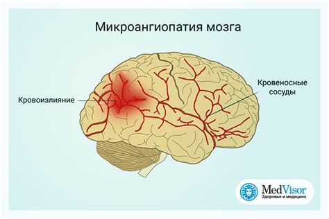 Причины глиоза и микроангиопатии головного мозга