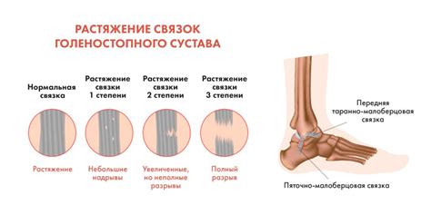 Причины и проявления растяжений щиколоточных связок: разбор симптомов