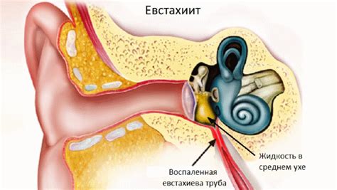 Причины и симптомы возникновения шума в слуховом аппарате при простуде