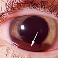 Причины и симптомы кровоизлияния в глаз