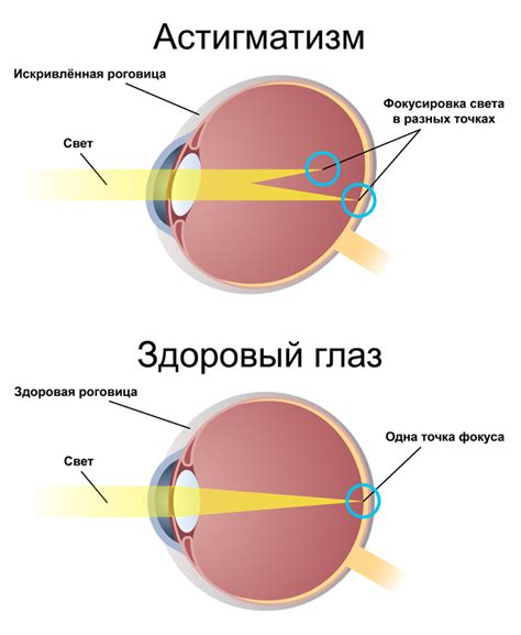 Причины развития астигматизма у взрослых