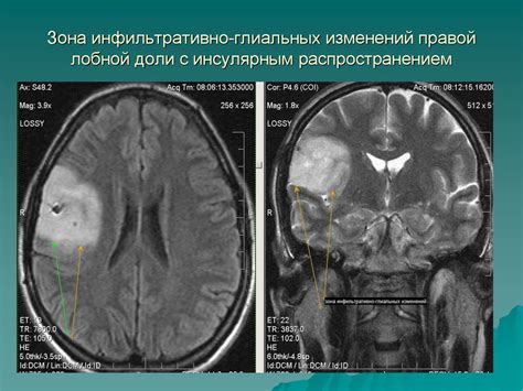 Причины развития глиомы правой лобной доли