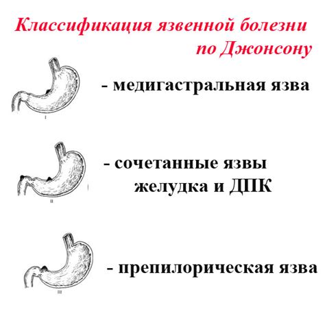 Профилактика повторного возникновения язвенной патологии