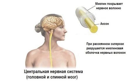 Рассеянный склероз и связь с недостатком определенных веществ