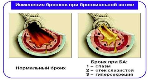 Расширители бронхов: механизм действия и методы применения