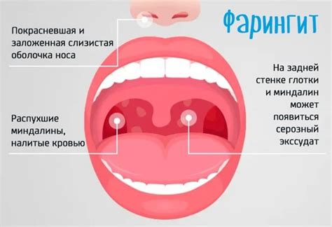 Рекомендации при гнойной ангине