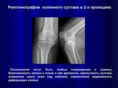 Рентгенография: классический способ оценки состояния хрящей в колене