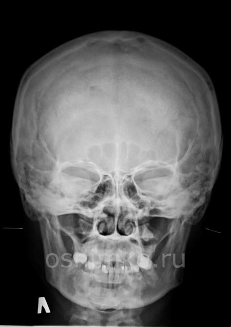 Рентгенография черепа: эффективный метод оценки состояния центральной нервной системы