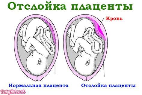 Роль гистологии плаценты в определении причин осложнений