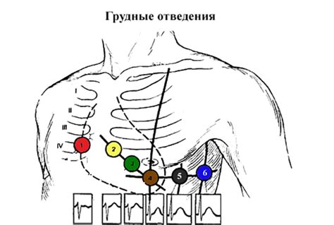 Роль отведений V1 V2 V3 в оценке состояния сердца по ЭКГ