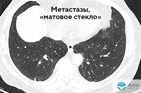 Роль состояний плотности на структуру легочной ткани при проведении компьютерной томографии: принципы и значимые аспекты