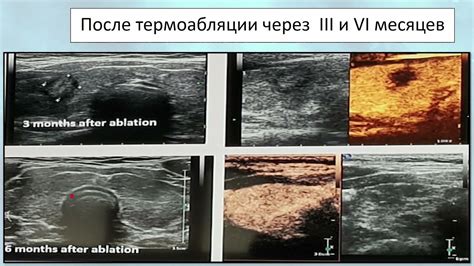 Роль ультразвукового исследования в выявлении патологических изменений щитовидной железы при нормальной функции гормонального фона