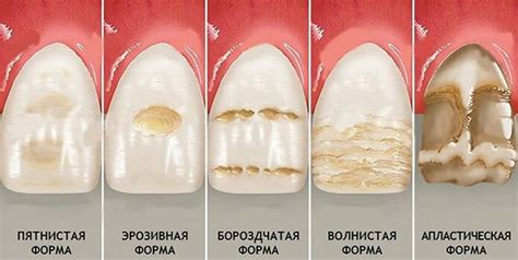 Симптомы гнилых зубов