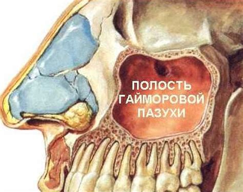 Симптомы гомогенного затемнения гайморовых пазух