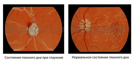 Симптомы и диагностика глаукомы