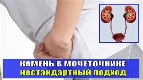 Симптомы и причины движения камня в мочеточнике