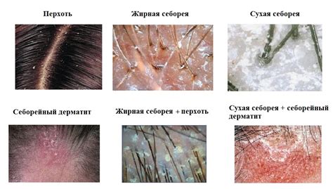 Снижение секреции кожи головы