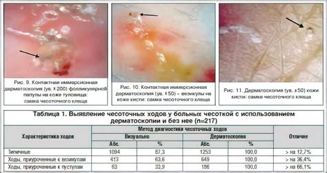 Современные методы диагностики чесотки: преимущества и недостатки