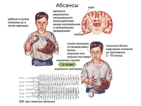 Современные подходы и перспективы лечения атак абсансов у детей с эпилепсией