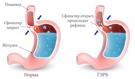 Способы устранения голодных спазмов в желудке