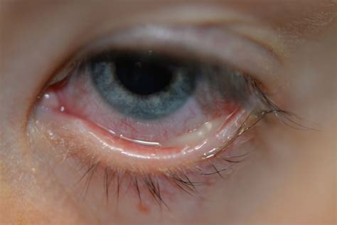 Сроки восстановления после лечения гнойных ниток в глазах