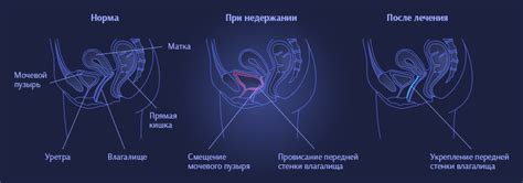 Стрессовое недержание мочи и возможности его излечения