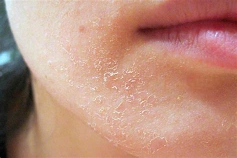 Сухость и отсутствие увлажнения кожи губ - факторы, повышающие риск трещин