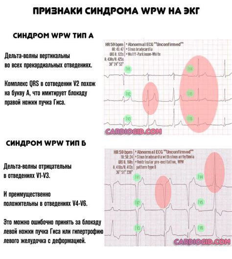 С-тип ЭКГ: что он сообщает нам?
