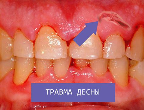 Травма или повреждение десны