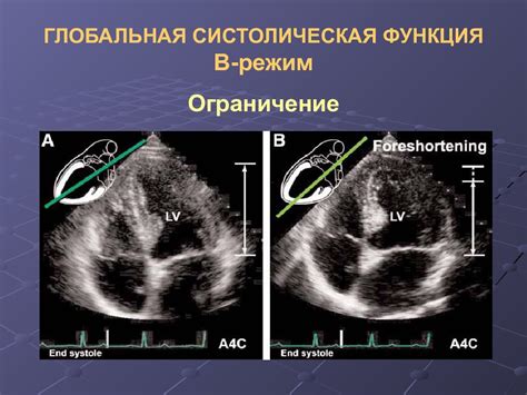 Факторы, способствующие сохранению глобальной систолической функции лж