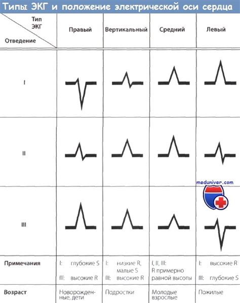 Что означает Эос полувертикальная на ЭКГ?