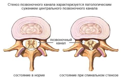 Что представляет собой несовершенство позвоночника в поясничном отделе