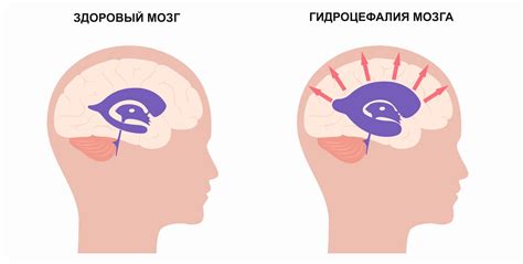 Что такое "гидроцефалия" и ее проявления