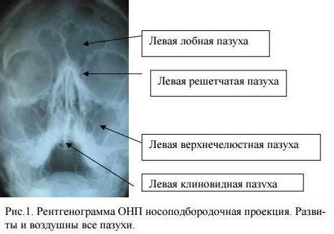 Что такое гомогенное затемнение гайморовых пазух?