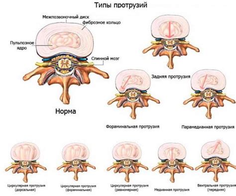 Что такое дорсальный выход диска L4-L5?