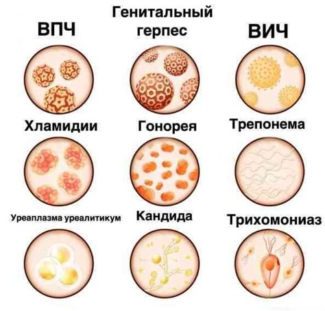 Что такое инфекция, передающаяся половым путем, и как она распространяется