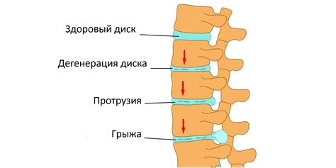 Что такое протрузия межпозвоночного диска и как она возникает?