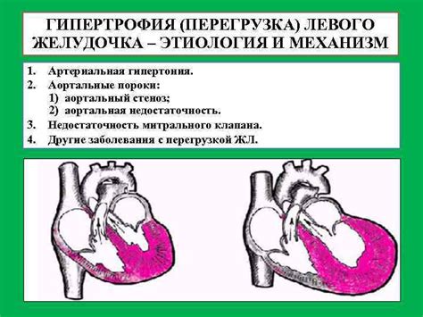 Эффективные методы устранения гипертрофии левого желудочка и их результаты