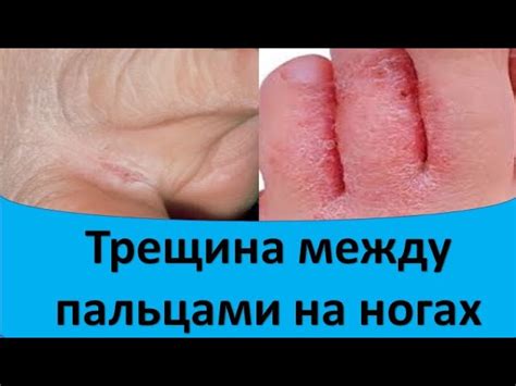  Возможные причины дребезжащей кожи между пальцами на ногах 