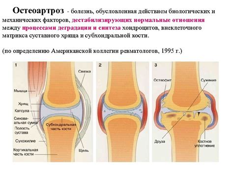  Воспалительные заболевания суставов и их роль в возникновении дискомфорта 