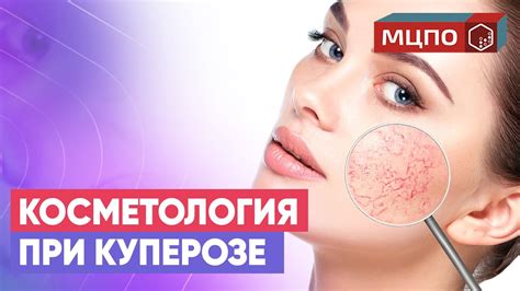  Народные методы и маски для устранения проблемы с сосудами на лице 