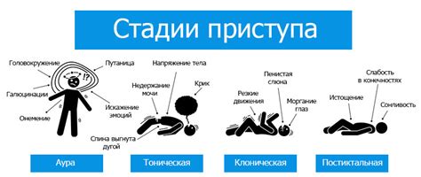  Этапы эпилептического приступа и его возникновение 